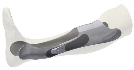 個性化加固設(shè)計的軟件工具，個性化加固設(shè)計的軟件工具 行業(yè)新聞 第3張